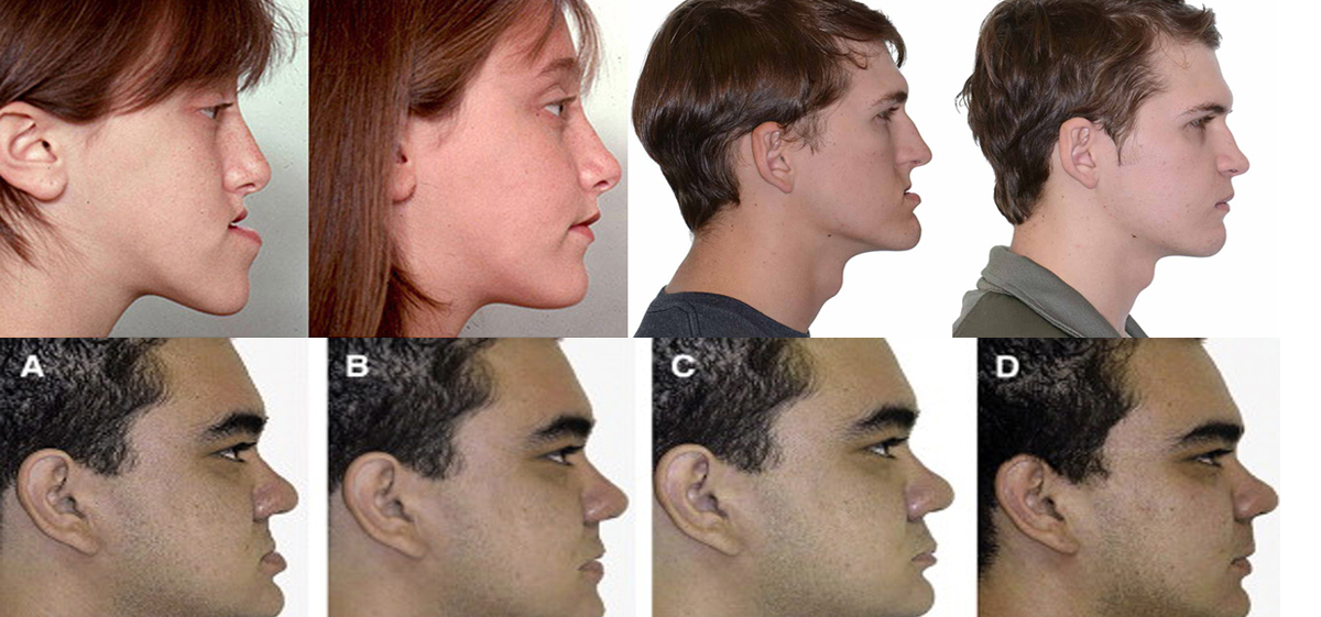 Orthognathic Surgery